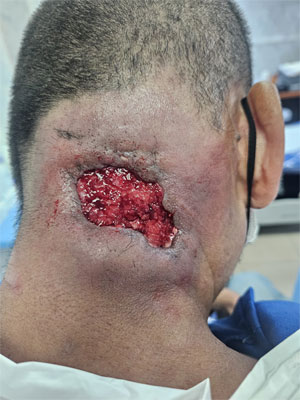 Hernia Discal -3