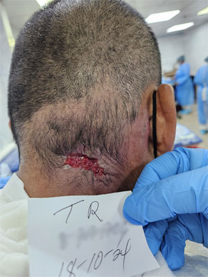 Hernia Discal -5